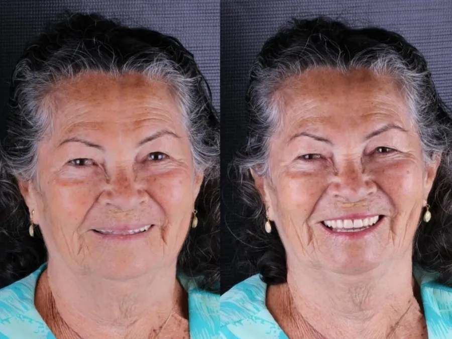 Revittale — Antes e depois — prótese